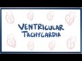 Ventricular tachycardia (VT) - causes, symptoms, diagnosis, treatment & pathology