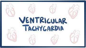 Ventricular tachycardia (VT) - causes, symptoms, diagnosis, treatment & pathology