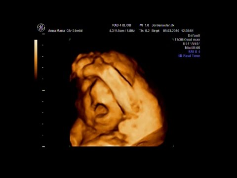 Wideo: Różnica Między Ultrasonografią 3D I 4D