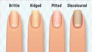 8 Things Your Nails Can Say About Your Health by Facts Line 1,260 views 6 years ago 4 minutes, 59 seconds