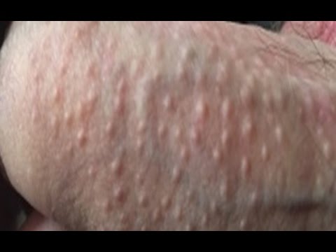 Fordyces Spots On Penis 115