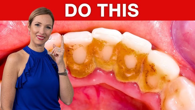 #1 TOP Remedy for DENTAL PLAQUE (Tartar) | Dr. Janine - YouTube