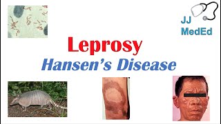 Leprosy (Hansen