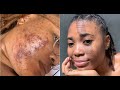 HOW I CLEARED UP MY CYSTIC ACNE| POST ROACCUTANE SCAR REMOVAL JOURNEY!