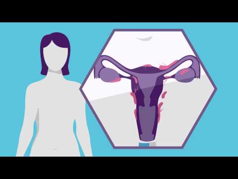 endometriosis-101:-moderate-to-severe?