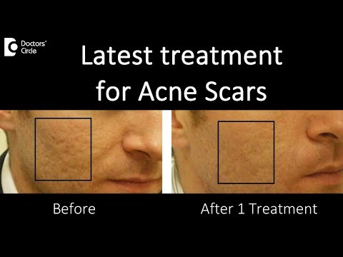 Best Treatment of Acne Scars - Dr. Urmila Nischal