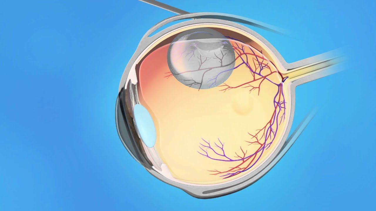 Пломбирование сетчатки. Регматогенная отслойка сетчатки. Отслойка сетчатки витрэктомия. Отслойка сетчатки глаза циркляж. Эписклеральное пломбирование сетчатки.
