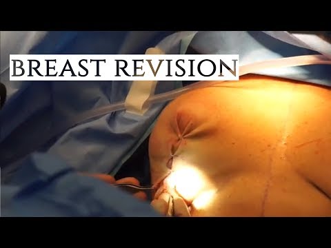 Dr. Barrett's Breast Revision | LIVE FOOTAGE!