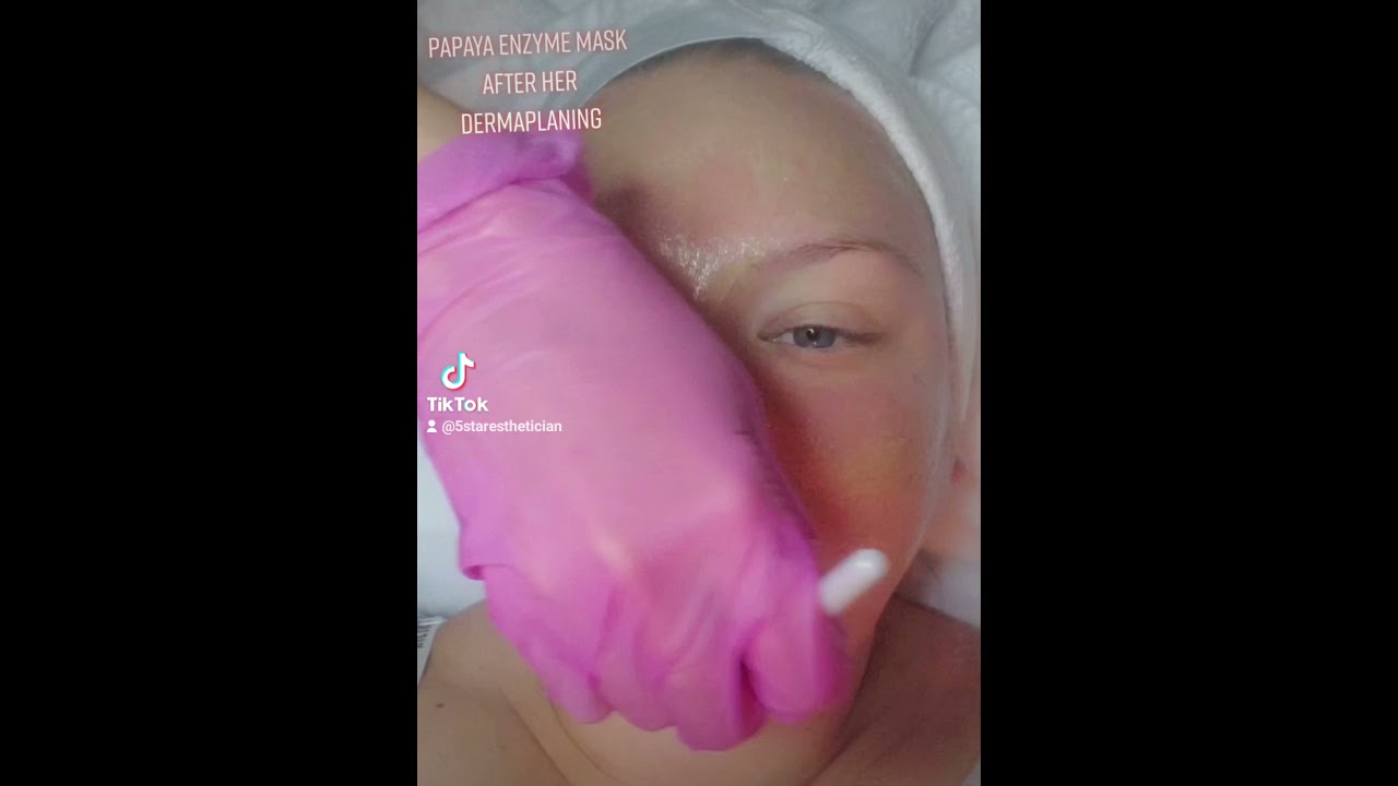 Papaya enzyme mask after her dermaplaning treatment.  perfect skin princess 👸.