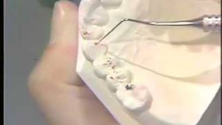 Analysis of Partially Edentulous Diagnostic Casts
