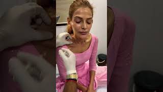 Botox treatment at transform clinic  #shorts #shortsvideo #youtubeshorts #khushi screenshot 5