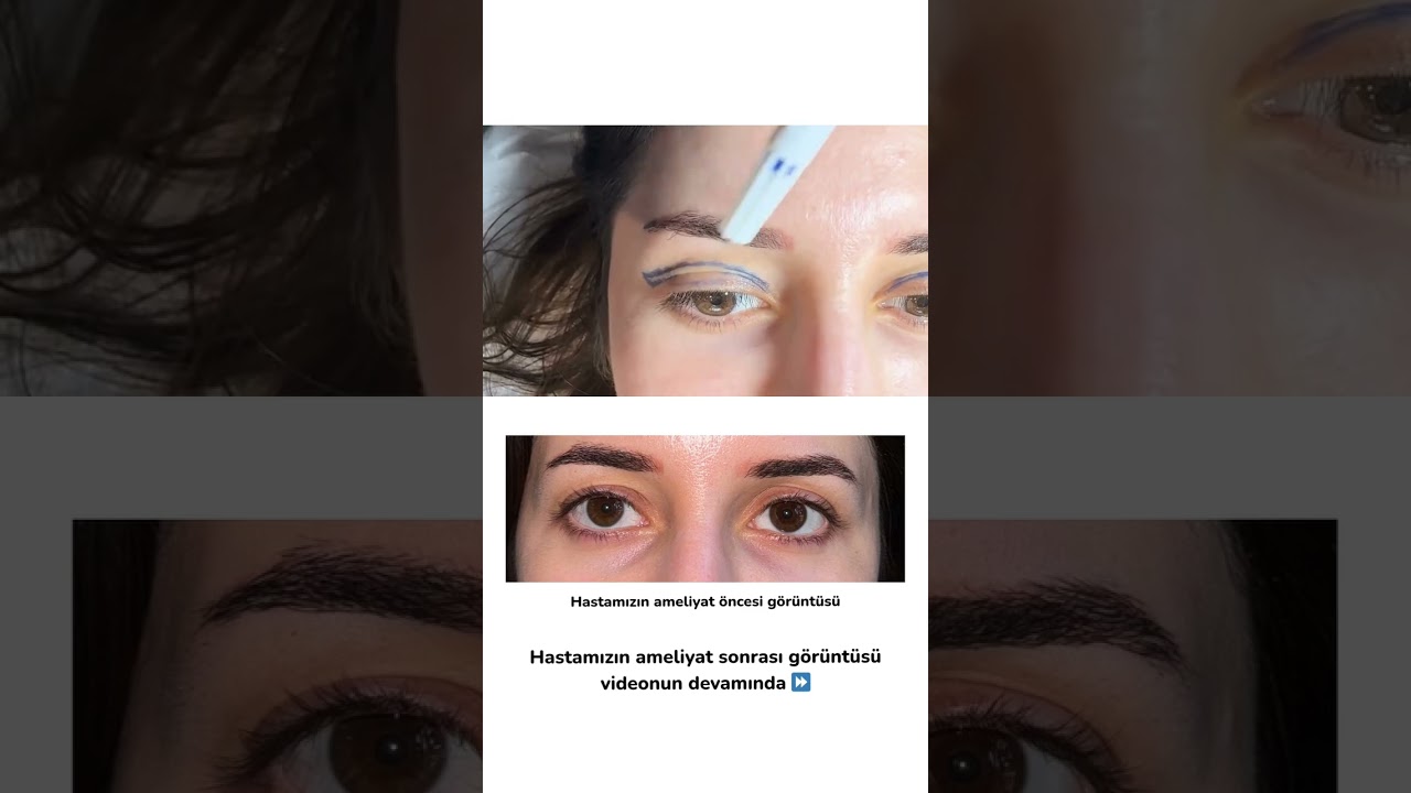 Üst Göz Kapağı ve Kaş Kaldırma Estetiği