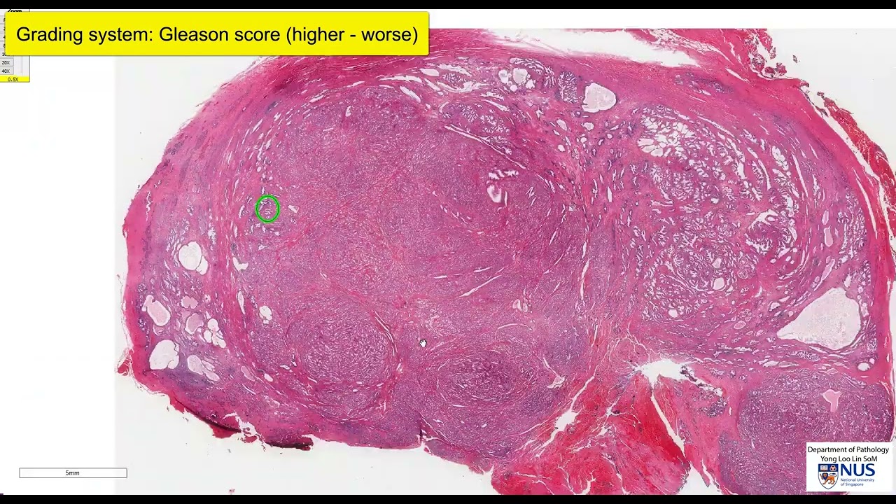 Предстательная железа: ацинарная аденокарцинома. Микроскопия. Говорящий слайд.