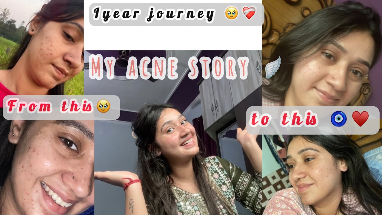 My acne journey || Ritika Chauhan vlogs|| |acneproblem || loveyourself|| 