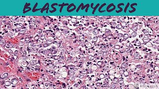 Blastomycosis: 5-Minute Pathology Pearls