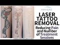 How Tattoos Removal can be Done with Less Pain, and Fewer Treatment Sessions