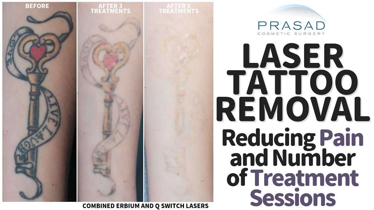 How Tattoos Removal Can Be Done With Less Pain, And Fewer Treatment Sessions