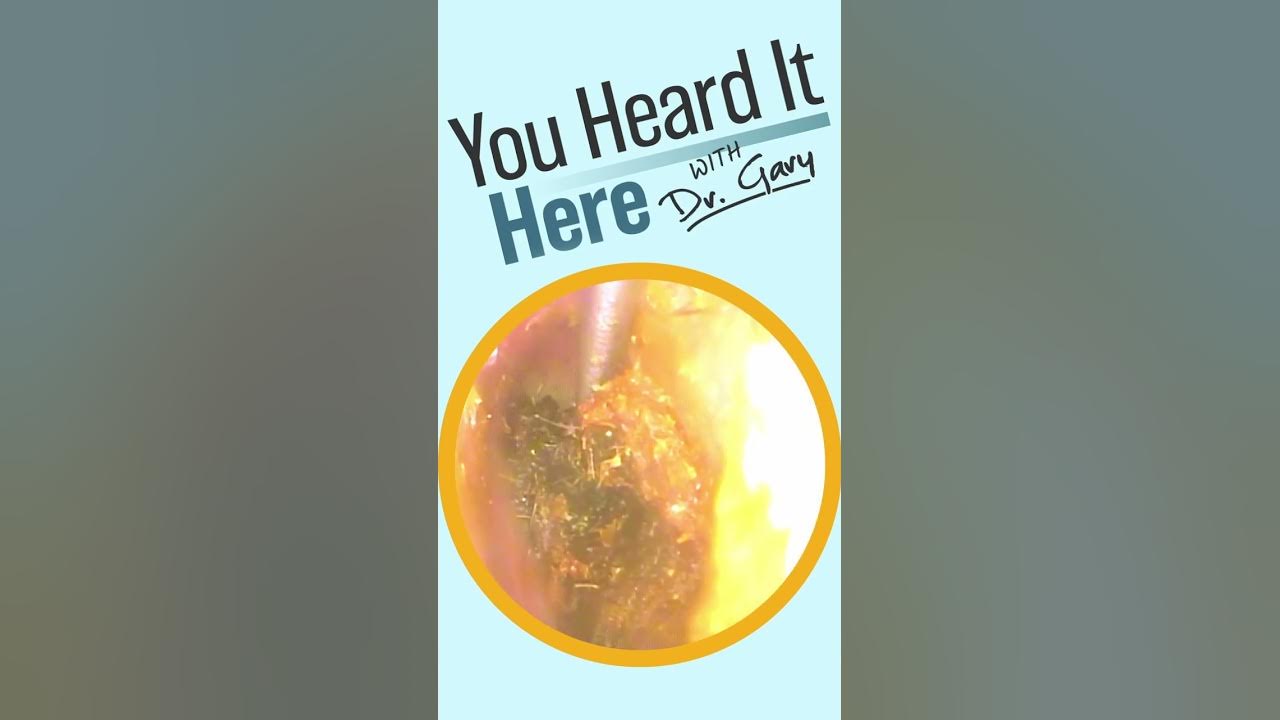 Old Wives Tale; Debunking the 'Ringing Ears' Myth Ear Wax Removal