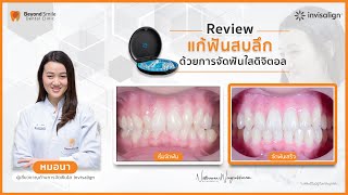 รีวิว before after, ข้อดี ข้อเสีย, การจัดฟันใส Invisalign แก้ฟันสบลึก ของหมอนา ที่ Beyond smile