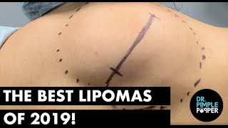 The Best Lipomas of 2019!