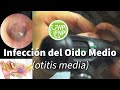 Infección del Oido Medio (otitis media)