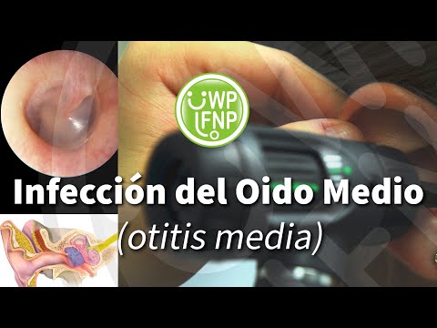 Video: La Otitis Crónica (infecciones De Oído) Y El Procedimiento Quirúrgico Que Llamamos TECA