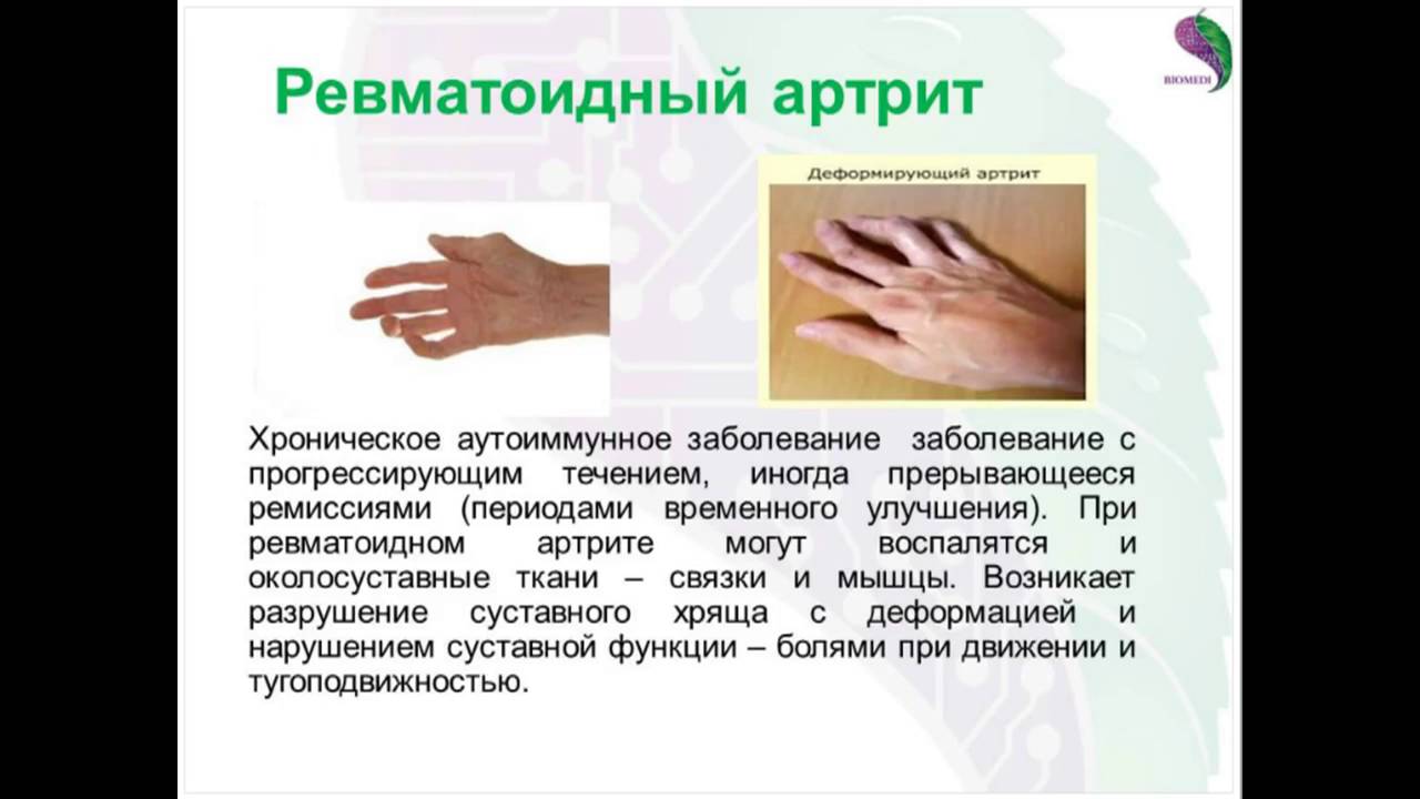 Лечение артрита, суставов, ревматоидного полиартрита и хронического ...