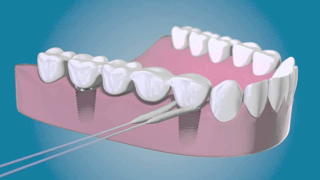 Como Limpiar Implantes Dentales Fijos Reinig rondom uw implantaten met de TePe Bridge & Implant Floss - YouTube