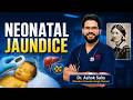 Neonatal jaundice - pediatrics #NORCET Voogly #Sahusirclass 3023 #nursingofficerexams