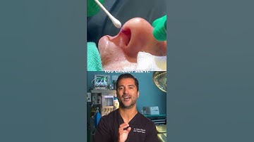 Open VS closed Rhinoplasty #openrhinoplasty #nosejob #rhinoplasty