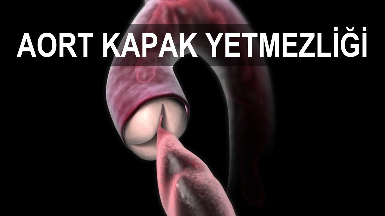 Aort Kapak Yetmezliği