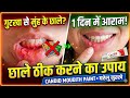 गुटखा पान मसाला से हुए मुंह के छाले कैसे ठीक करें? Candid Mouth Paint Use & Review