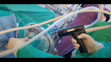 Swiss LithoClast® Trilogy miniperc Swiss LithoClast® Miniperc