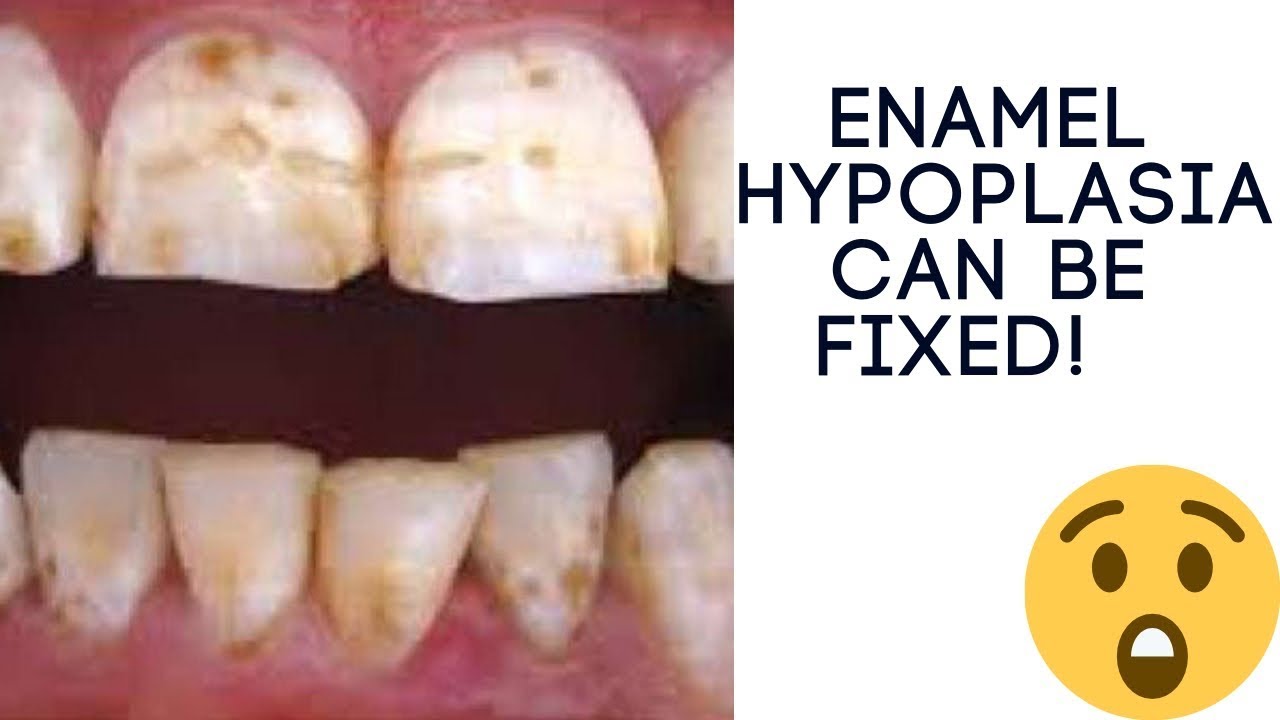 Does Enamel hypoplasia Cause White Spots On Teeth? YouTube