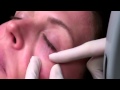 Long pulse 1064nm laser treatment of blue veins around eyes.mp4