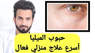 حبوب الميليا الحبوب البيضاء في الوجه تحت العين اسرع علاج منزلي فعال - دكتور طلال المحيسن