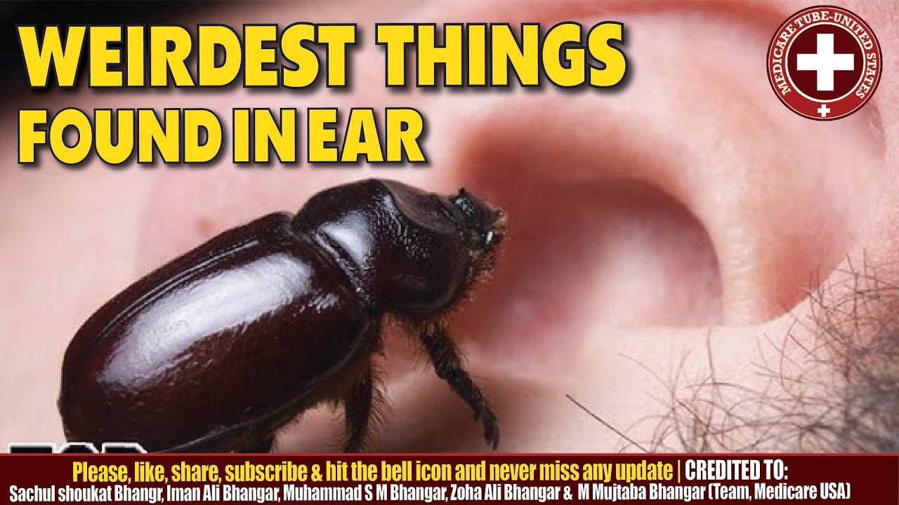 Weirdest Things Found in Ears! (Safe & Shocking Discoveries 🤯) YouTube