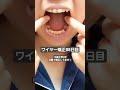 歯列矯正 88日目の記録 歯列矯正 88日目の記録