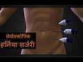 लैप्रोस्कोपिक अम्बिलिकल हर्निया सर्जरी  Laparoscopic Incisional or Umbilical Hernia Surgery Hindi