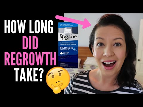 what-to-expect-when-starting-rogaine-or-minoxidil,-how-long-does-it-take-to-work-(and-weddings-talk)
