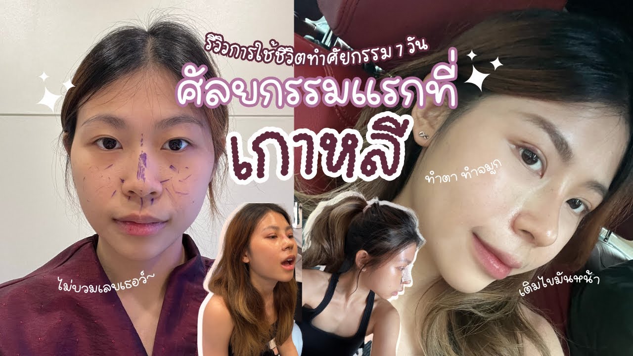 ศัลยกรรมครั้งแรกในชีวิตก็เกาหลีเลย I Vlog ศัลเกาหลี 7 วันใช้ชีวิตยังไง!