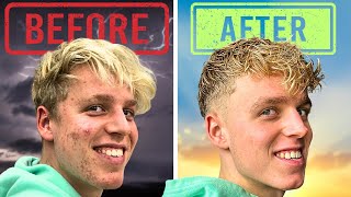 Download Lagu MIJN STRIJD MET ACNE ❤️‍🩹 MP3