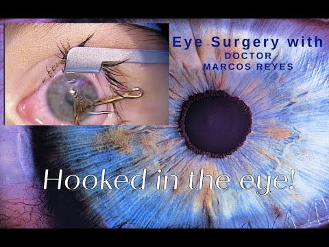 Hooked…in the eye!