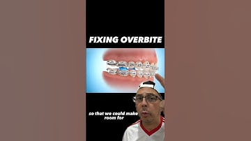 How to Properly Fix an Overbite with Braces | View Mobile Dental #shorts