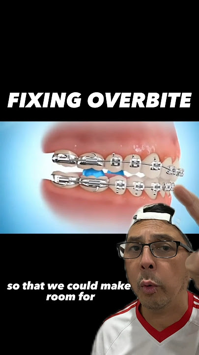 How to Properly Fix an Overbite with Braces | View Mobile Dental #shorts