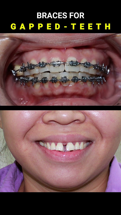 BRACES FOR GAPPED TEETH. 32 MONTHS DURATION #braces #orthodontist #dentist