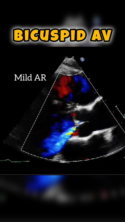 Bicuspid Aortic Valve - Echocardiography for beginners #heart #Echo
