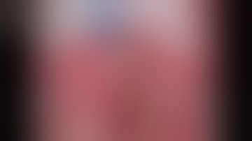 Total gastrectomy  and pouch esophagojejunostomy  Part II