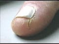 DermTV - How to Heal Cracked Fingertips [DermTV.com Epi #125]