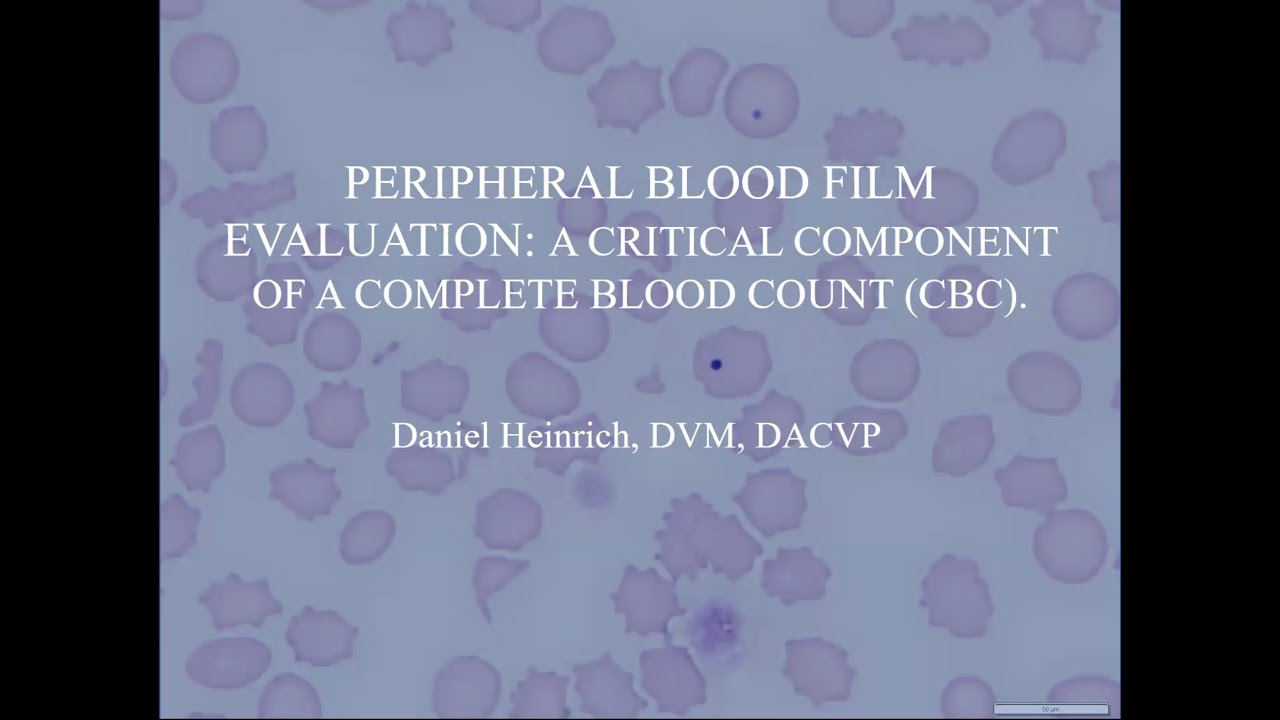 Peripheral Blood Film Evaluation A Critical Component Of A Complete Peripheral Blood Film Evaluation A Critical Component Of A Complete